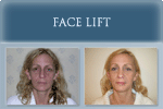 Face Lift - Photo