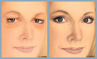 Blepharoplasty - Diagram