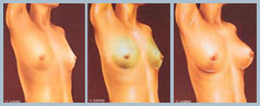 Breast Augmentation - Diagram