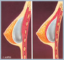 Breast Augmentation - Diagram