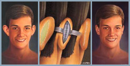 Otoplasty - Diagram