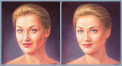 Skin Fillers - Diagram