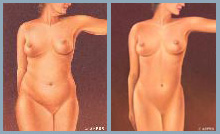 Liposuction - Diagram