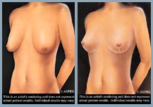Breast Lift - Diagram