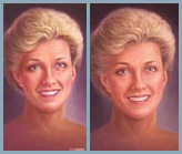 Skin Peel - Diagram