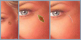 Skin Cancer / Moles - Diagram