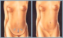 Tummy Tuck (Abdominoplasty) - Diagram